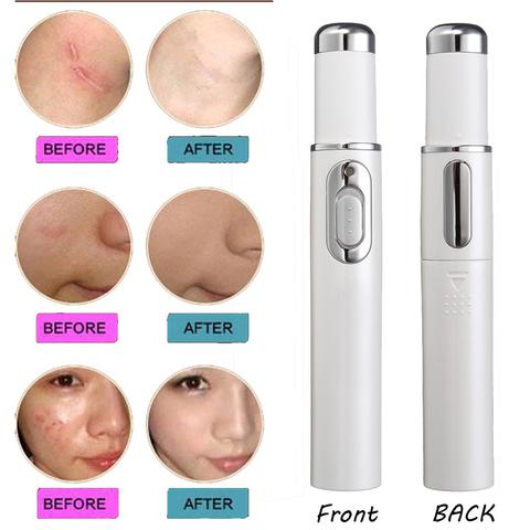 Therapy Acne Laser Pen